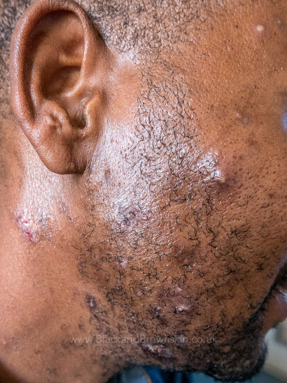 P1010132-46medical,+staphylococcal+skin+infection,+sycosis+barbae