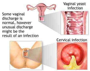 vaginal_discharge_rishma_pai