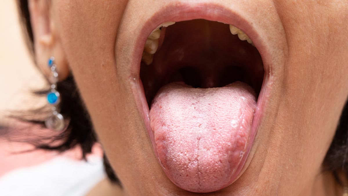 Main-oral-candidiasis