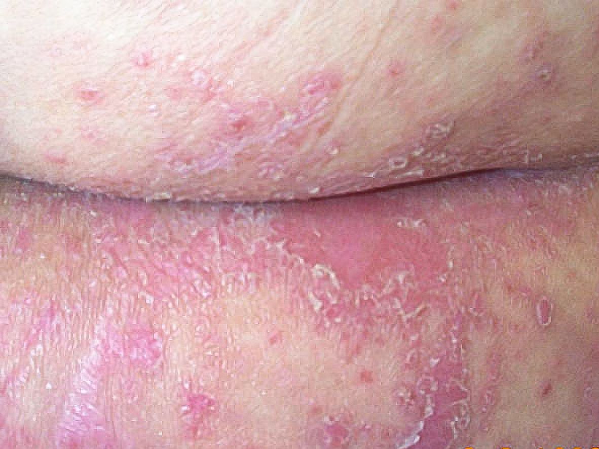 VWH-DermNetNZ-Intertrigo-02-bdd3755cc050401c91893838f88673f4