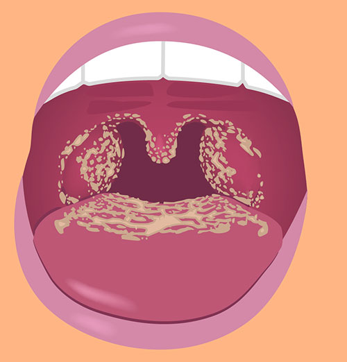 candida_infection_illustrations