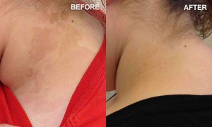skinfungal3-300x180